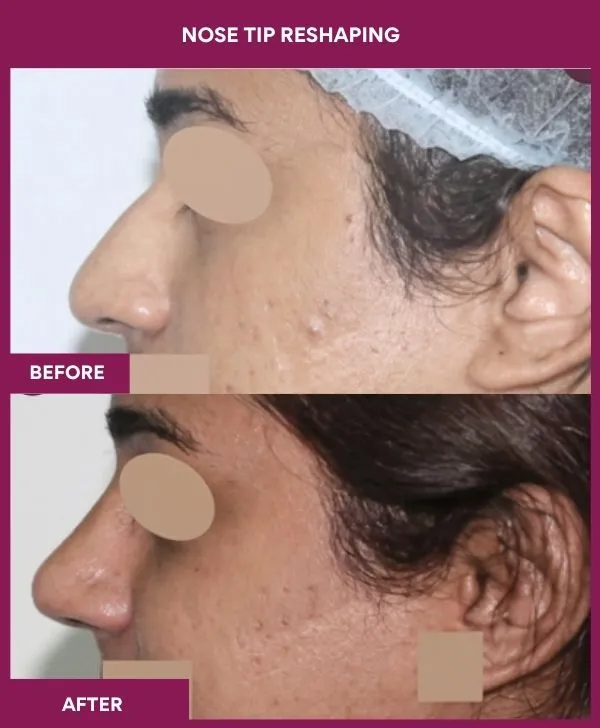 nose-tip-reshaping-before-after-results-mumbai-india-patient02-side-left