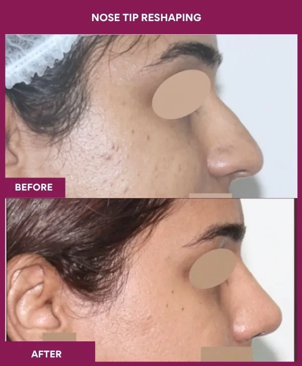 nose-tip-reshaping-before-after-results-mumbai-india-patient02-side-right