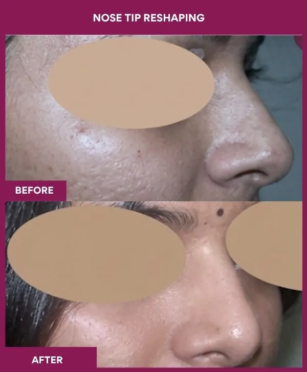 nose-tip-reshaping-before-after-results-mumbai-india-patient03-front-right