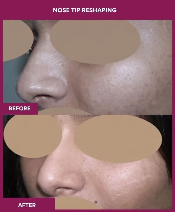 nose-tip-reshaping-before-after-results-mumbai-india-patient03-side-left