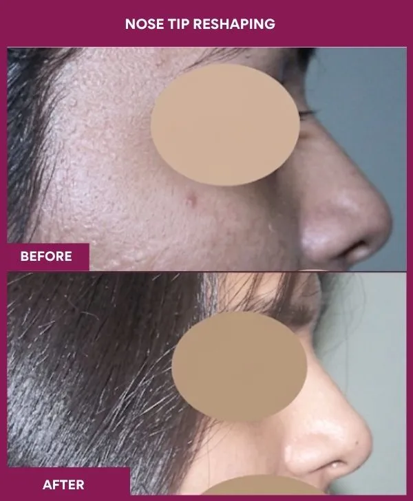 nose-tip-reshaping-before-after-results-mumbai-india-patient03-side-right