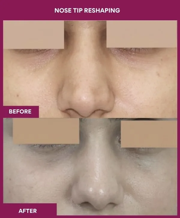 nose-tip-reshaping-before-after-results-mumbai-india-patient04-front