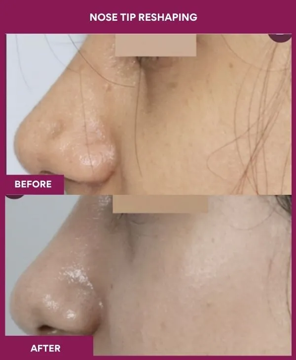 nose-tip-reshaping-before-after-results-mumbai-india-patient04-side-left