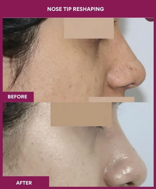 nose-tip-reshaping-before-after-results-mumbai-india-patient04-side-right