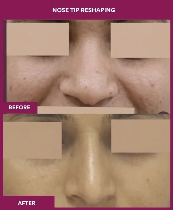 nose-tip-reshaping-before-after-results-mumbai-india-patient05-front
