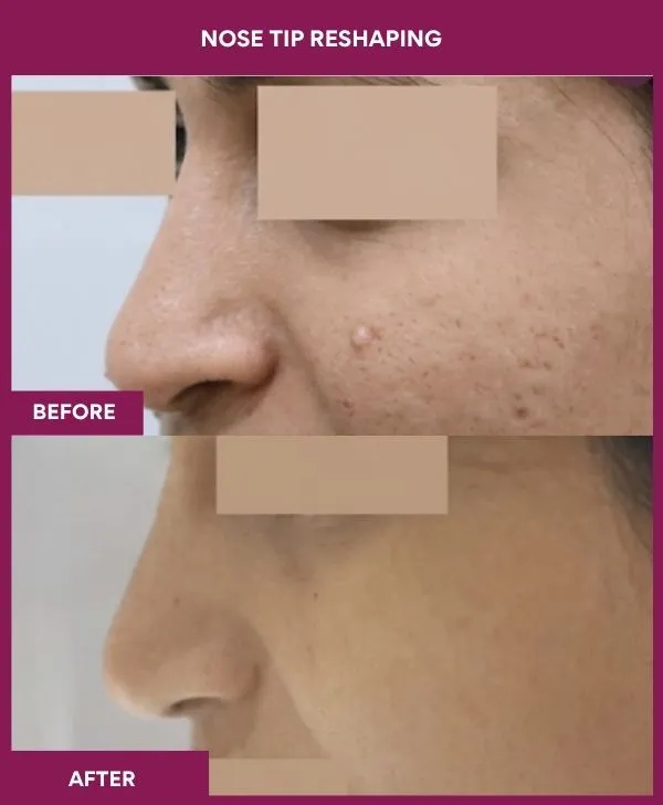 nose-tip-reshaping-before-after-results-mumbai-india-patient05-side-left