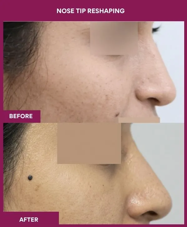 nose-tip-reshaping-before-after-results-mumbai-india-patient05-side-right