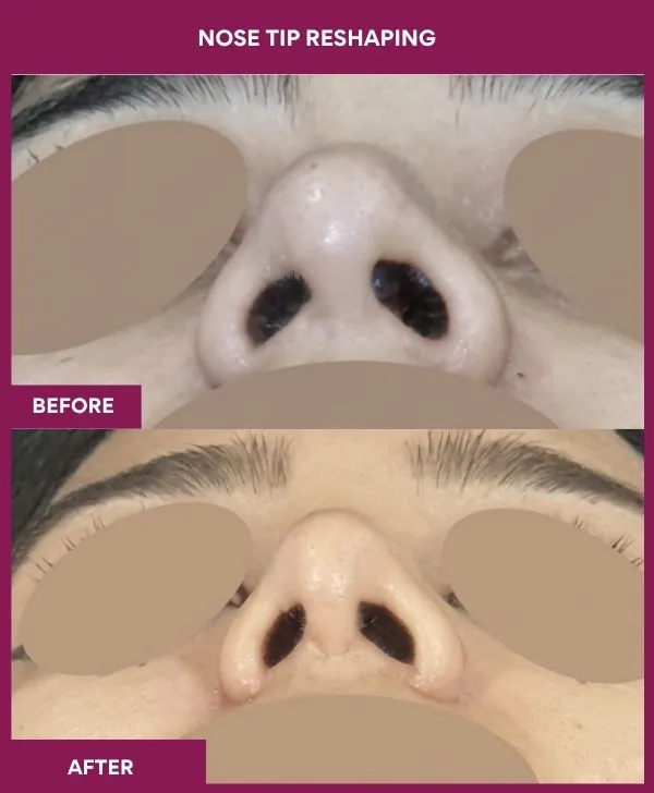 nose-tip-reshaping-before-after-results-mumbai-india-patient06-front-up