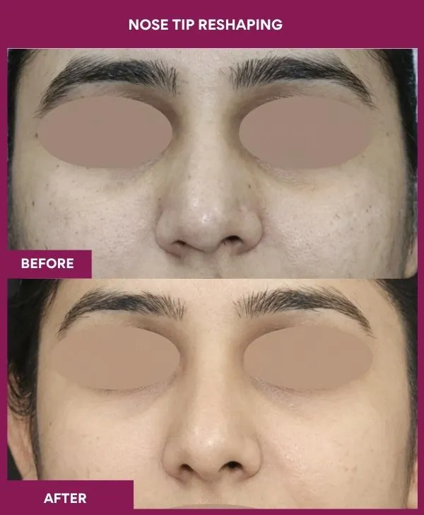 nose-tip-reshaping-before-after-results-mumbai-india-patient06-front