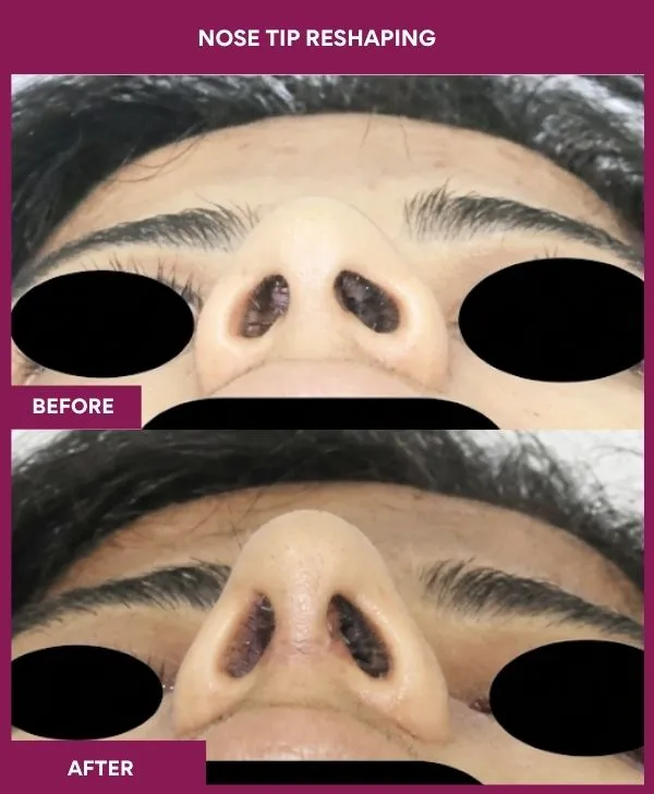 nose-tip-reshaping-before-after-results-mumbai-india-patient07-front-up
