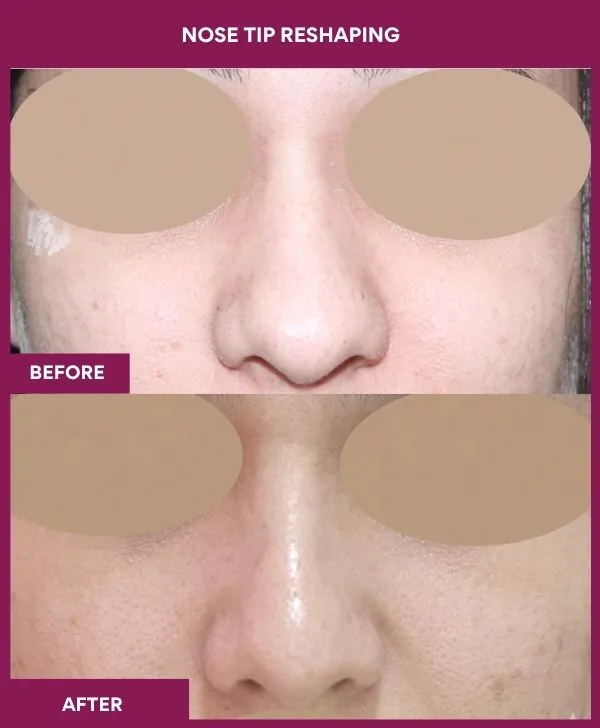 nose-tip-reshaping-before-after-results-mumbai-india-patient08-front