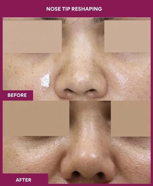 nose-tip-reshaping-before-after-results-mumbai-india-patient09-front
