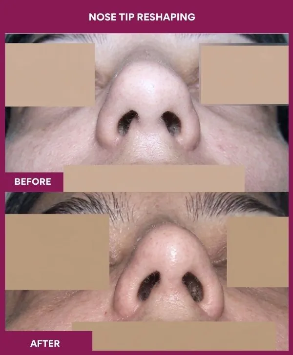 nose-tip-reshaping-before-after-results-mumbai-india-patient10-front-up