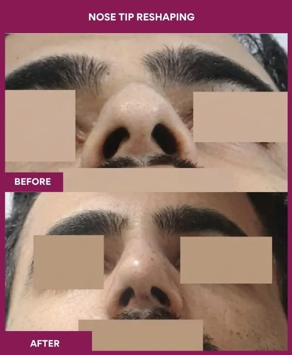 nose-tip-reshaping-before-after-results-mumbai-india-patient11-front-up