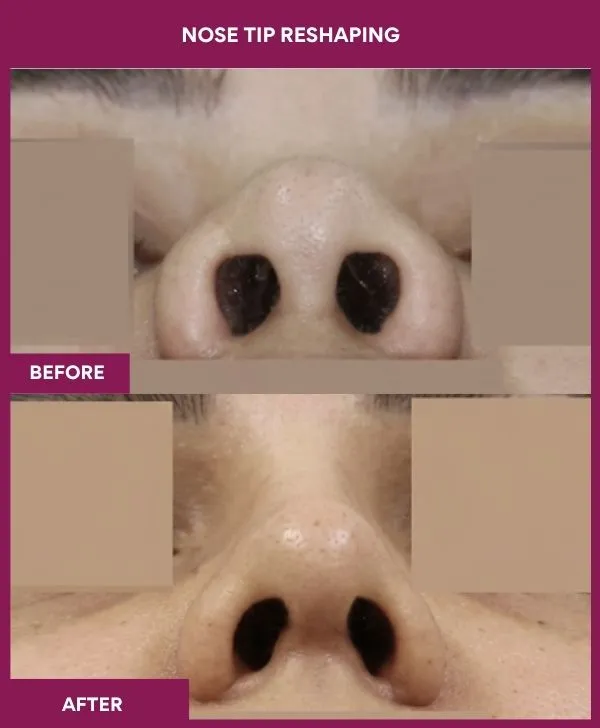 nose-tip-reshaping-before-after-results-mumbai-india-patient12-front-up