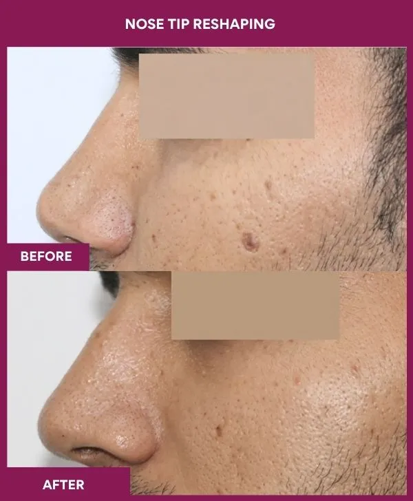nose-tip-reshaping-before-after-results-mumbai-india-patient13-side-left