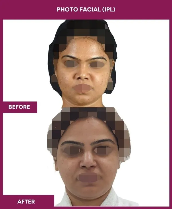photofacial-laser-treatment-before-after-results-mumbai-india-patient01-front