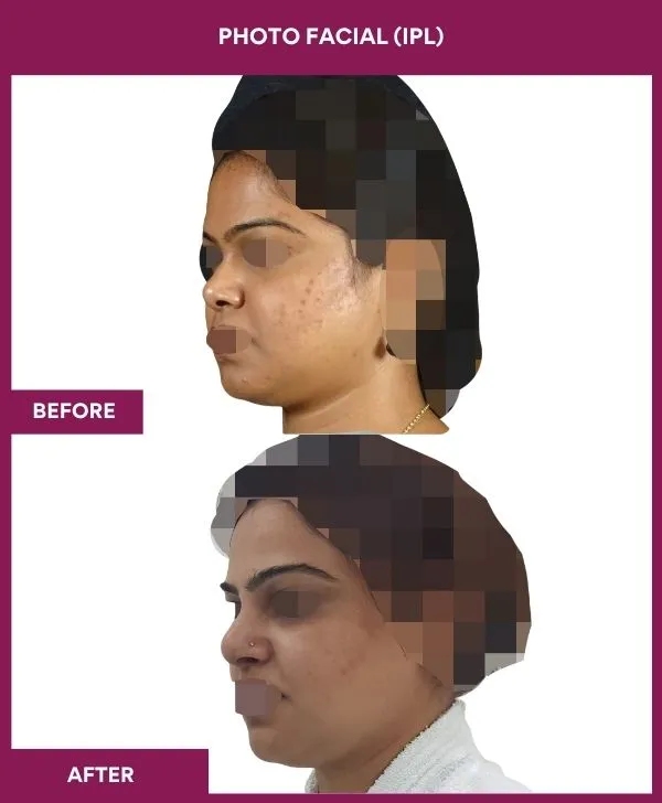 photofacial-laser-treatment-before-after-results-mumbai-india-patient01-side-left