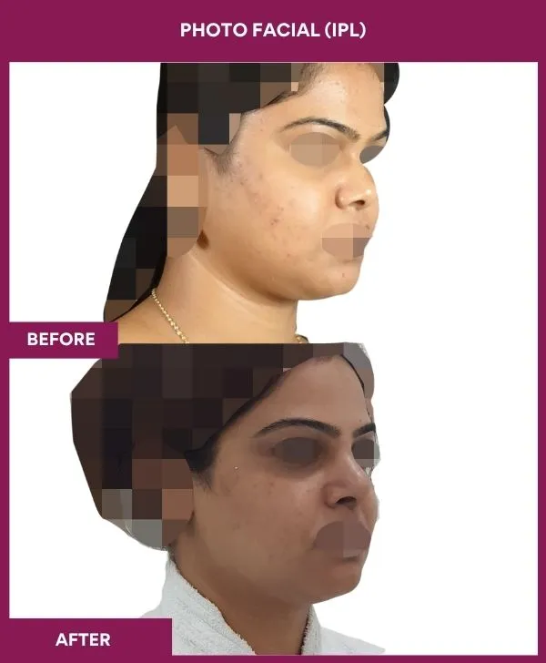 photofacial-laser-treatment-before-after-results-mumbai-india-patient01-side-right