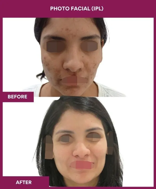 photofacial-laser-treatment-before-after-results-mumbai-india-patient02-front