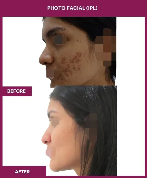 photofacial-laser-treatment-before-after-results-mumbai-india-patient02-side-left