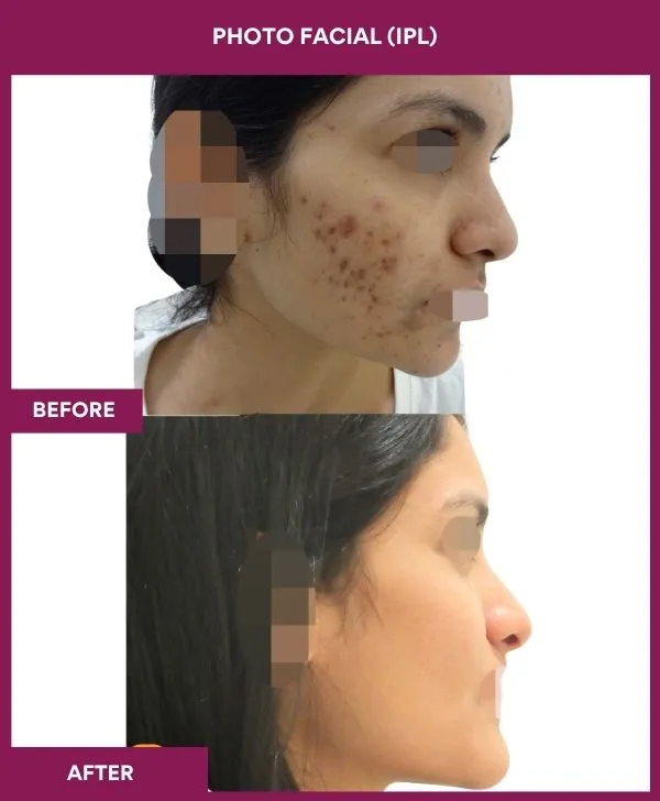 photofacial-laser-treatment-before-after-results-mumbai-india-patient02-side-right