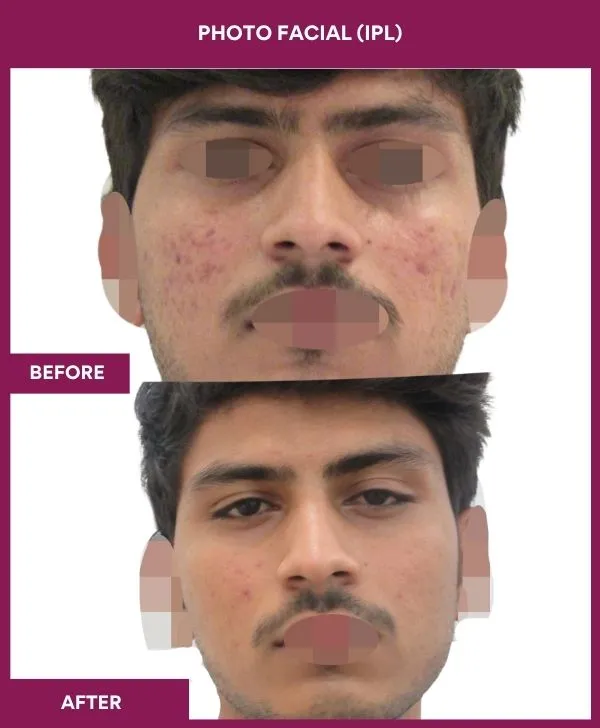 photofacial-laser-treatment-before-after-results-mumbai-india-patient03-front