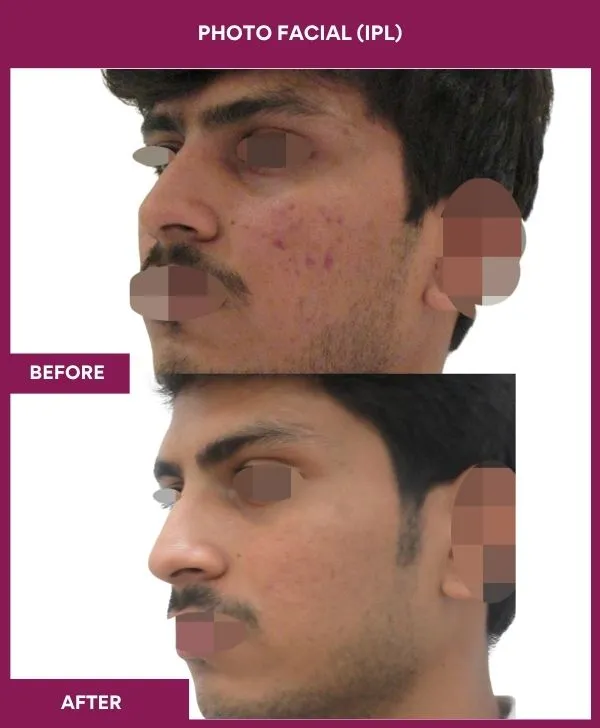 photofacial-laser-treatment-before-after-results-mumbai-india-patient03-side-left