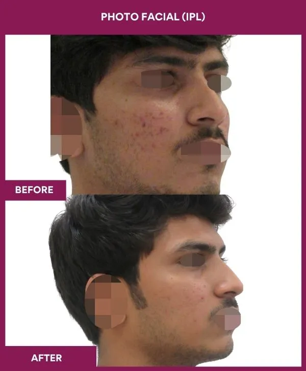 photofacial-laser-treatment-before-after-results-mumbai-india-patient03-side-right