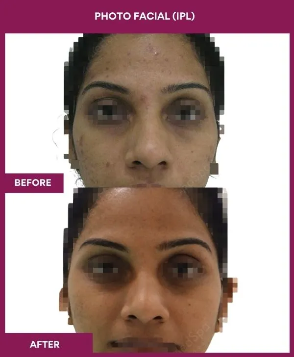 photofacial-laser-treatment-before-after-results-mumbai-india-patient04-front