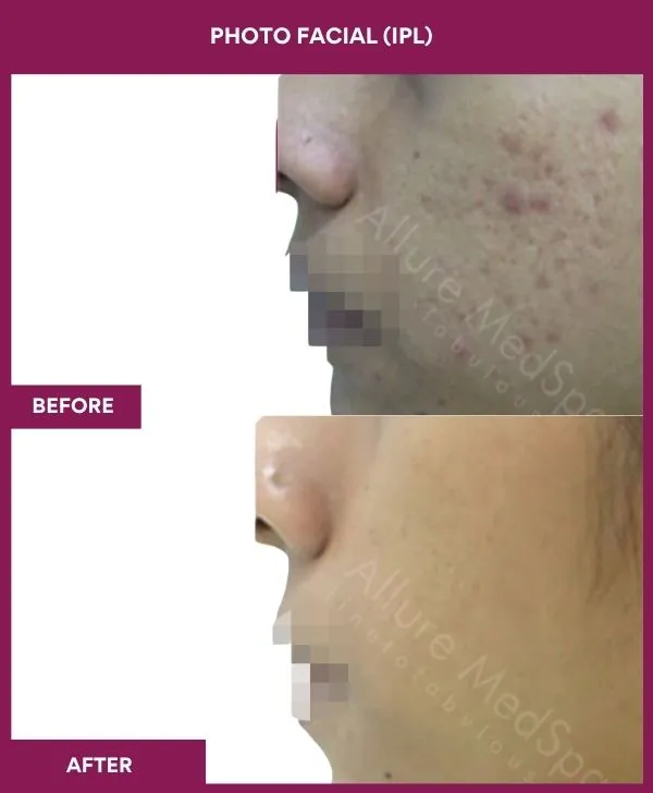 photofacial-laser-treatment-before-after-results-mumbai-india-patient04-side-left