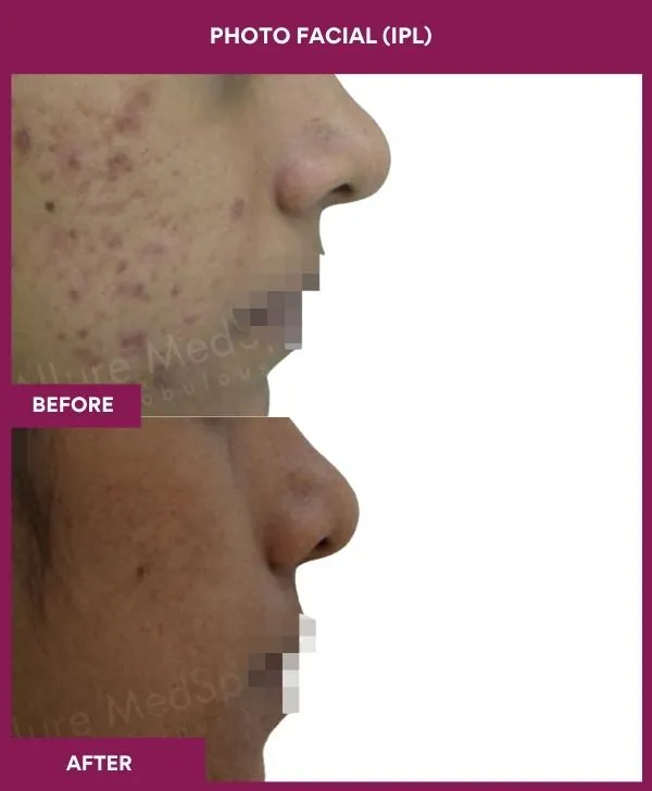 photofacial-laser-treatment-before-after-results-mumbai-india-patient04-side-right