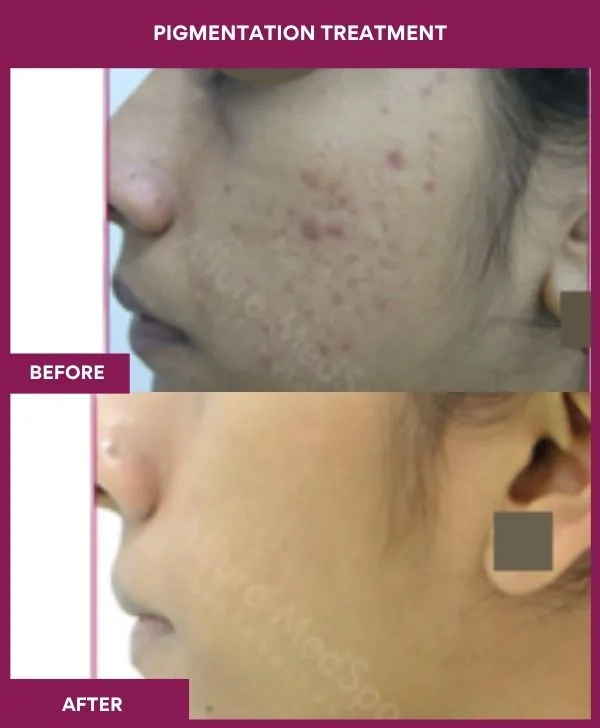 glutathione for melasma testimony Pigmentation Treatment in Mumbai This finally came in Size:1 cryovial تونر فيتامين سي