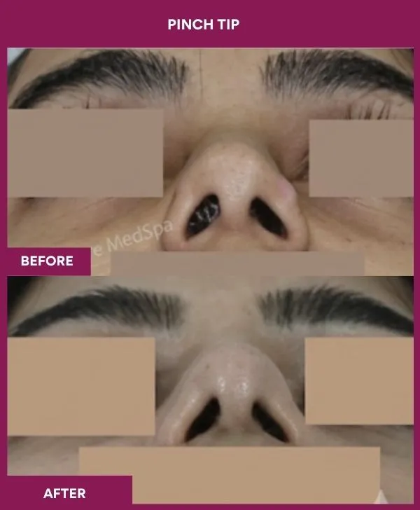 pinch-tip-rhinoplasty-before-after-results-mumbai-india-patient01-front