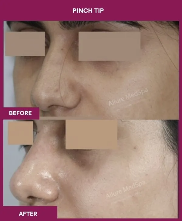 pinch-tip-rhinoplasty-before-after-results-mumbai-india-patient01-side-left
