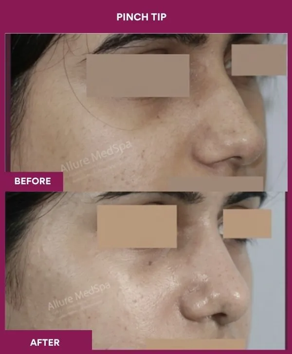 pinch-tip-rhinoplasty-before-after-results-mumbai-india-patient01-side-right
