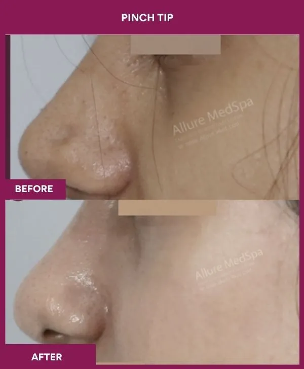 pinch-tip-rhinoplasty-before-after-results-mumbai-india-patient02-side-left