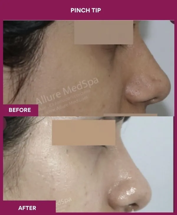 pinch-tip-rhinoplasty-before-after-results-mumbai-india-patient02-side-right