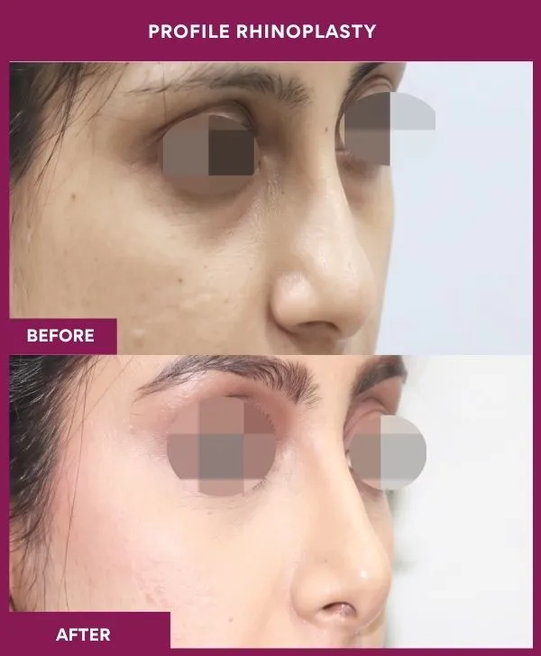 profile-rhinoplasty-before-after-results-mumbai-india-patient01-side-front-right