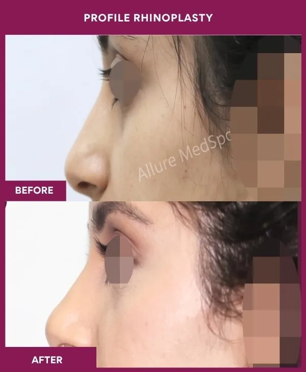 profile-rhinoplasty-before-after-results-mumbai-india-patient01-side-left