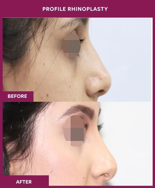 profile-rhinoplasty-before-after-results-mumbai-india-patient01-side-right