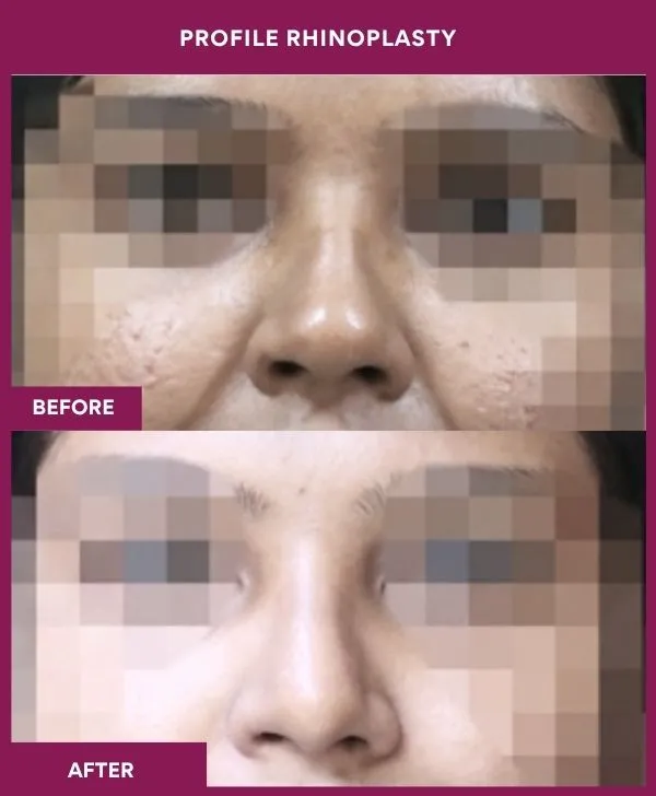 profile-rhinoplasty-before-after-results-mumbai-india-patient02-front