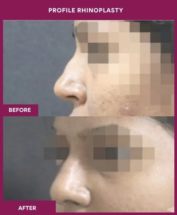 profile-rhinoplasty-before-after-results-mumbai-india-patient02-side-left