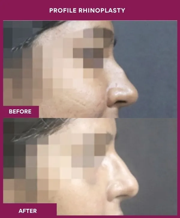 profile-rhinoplasty-before-after-results-mumbai-india-patient02-side-right