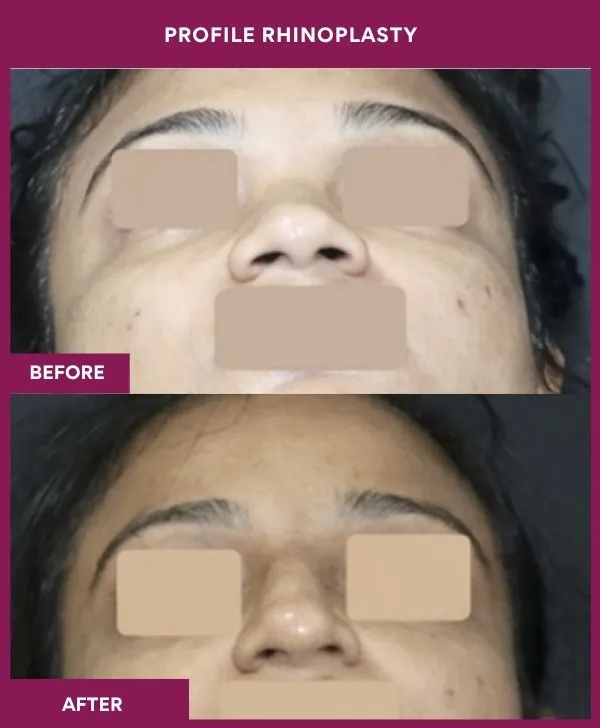 profile-rhinoplasty-before-after-results-mumbai-india-patient03-front
