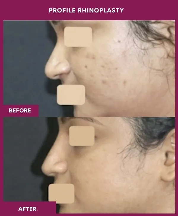 profile-rhinoplasty-before-after-results-mumbai-india-patient03-side-left