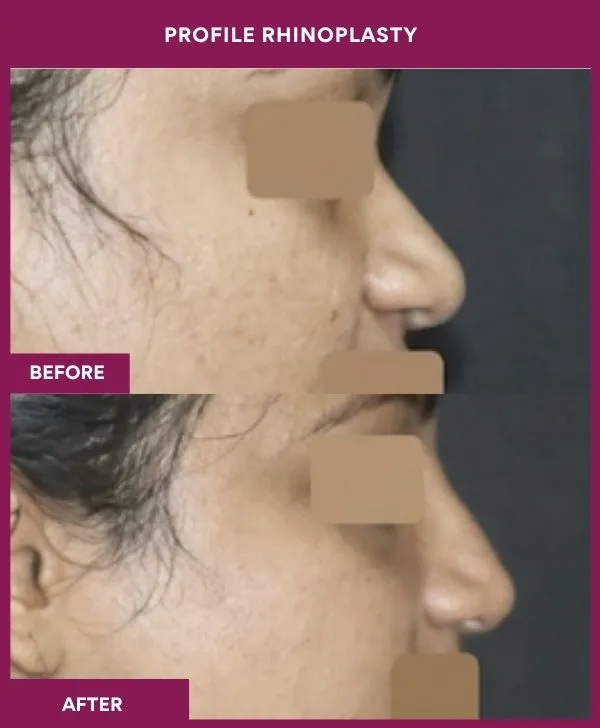 profile-rhinoplasty-before-after-results-mumbai-india-patient03-side-right