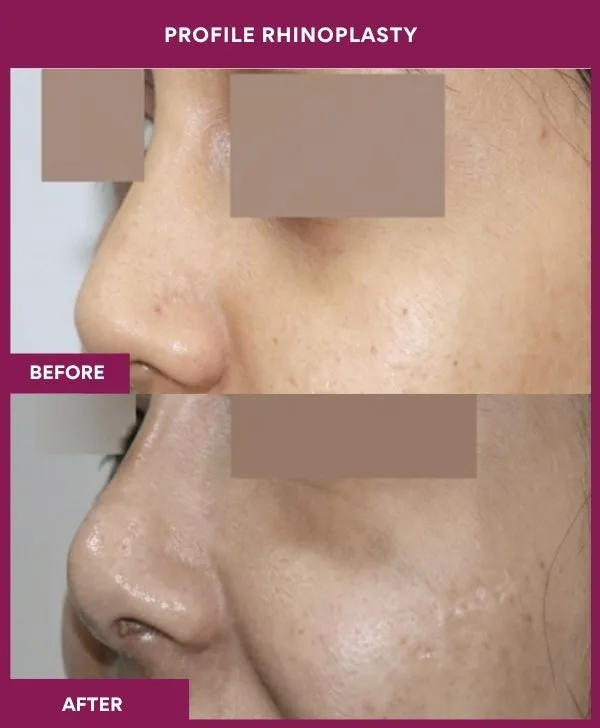 profile-rhinoplasty-before-after-results-mumbai-india-patient04-front-left