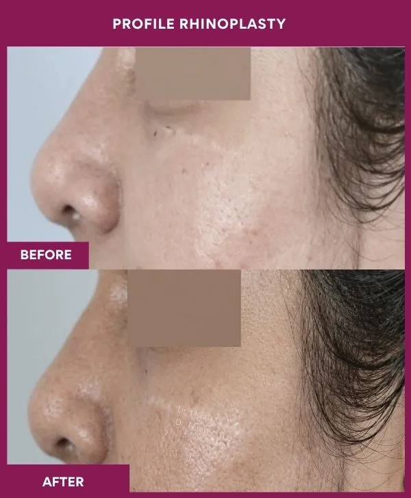 profile-rhinoplasty-before-after-results-mumbai-india-patient04-side-left