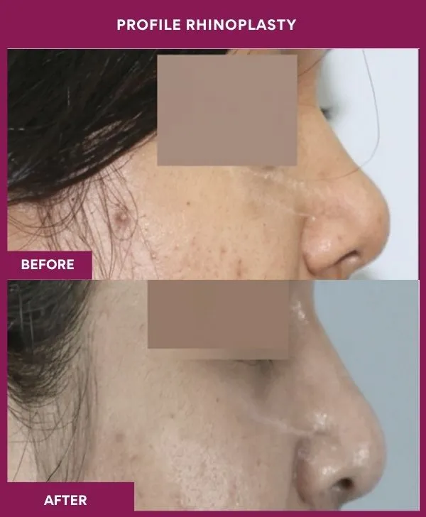 profile-rhinoplasty-before-after-results-mumbai-india-patient04-side-right